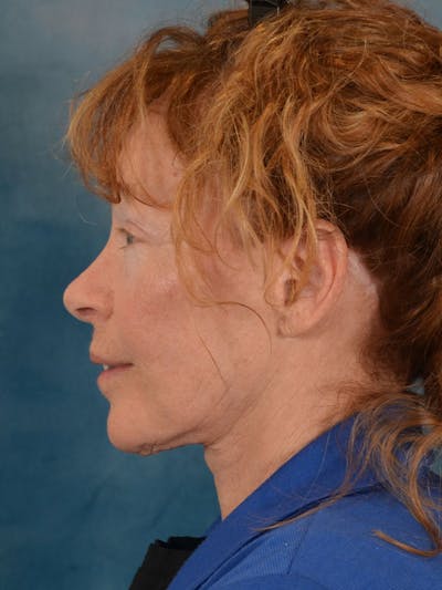 Brow Lift Before & After Gallery - Patient 306928 - Image 6