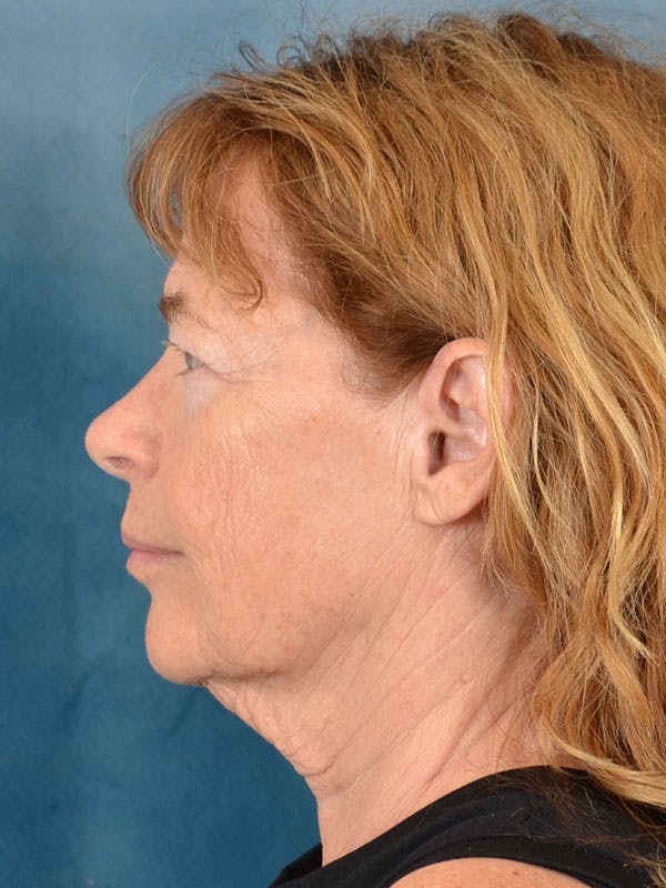 Brow Lift Before & After Gallery - Patient 306928 - Image 5