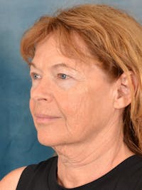Deep Plane Facelift Before & After Gallery - Patient 264283 - Image 1