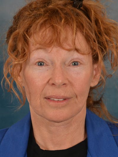 Brow Lift Before & After Gallery - Patient 306928 - Image 2