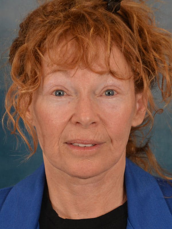 Brow Lift Before & After Gallery - Patient 306928 - Image 2