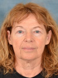 Brow Lift Before & After Gallery - Patient 306928 - Image 1