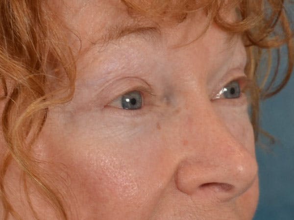 Eyelid Lift Before & After Gallery - Patient 741269 - Image 4