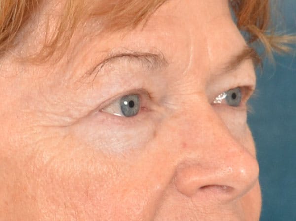 Eyelid Lift Before & After Gallery - Patient 741269 - Image 3