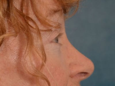 Eyelid Lift Before & After Gallery - Patient 741269 - Image 6