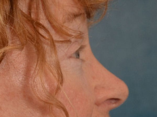 Eyelid Lift Before & After Gallery - Patient 741269 - Image 6