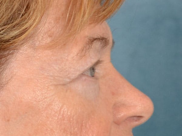 Eyelid Lift Before & After Gallery - Patient 741269 - Image 5