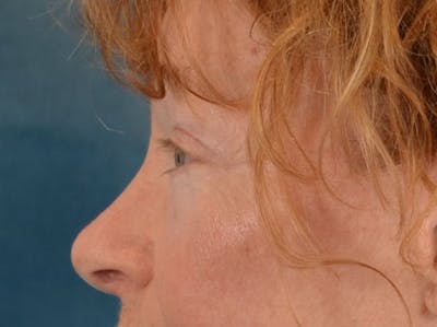 Eyelid Lift Before & After Gallery - Patient 741269 - Image 8