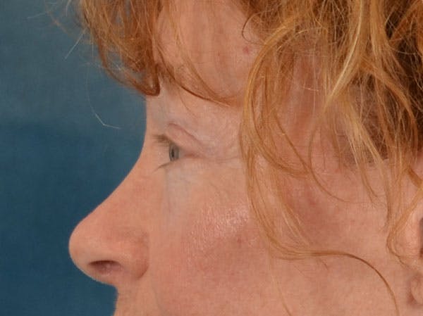 Eyelid Lift Before & After Gallery - Patient 741269 - Image 8