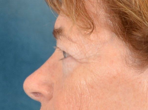 Eyelid Lift Before & After Gallery - Patient 741269 - Image 7
