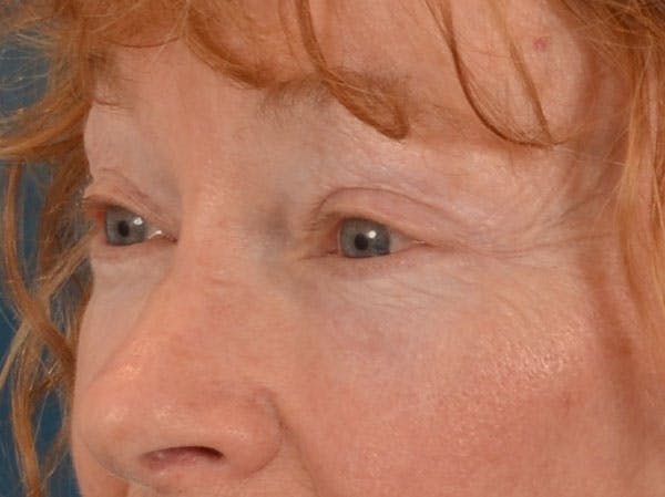 Eyelid Lift Before & After Gallery - Patient 741269 - Image 10