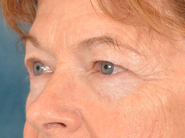 Eyelid Lift Before & After Gallery - Patient 741269 - Image 9