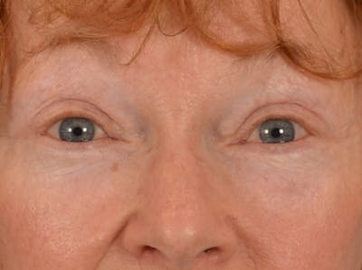Eyelid Lift Before & After Gallery - Patient 741269 - Image 2