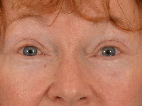 Eyelid Lift Before & After Gallery - Patient 741269 - Image 2