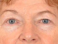 Eyelid Lift Before & After Gallery - Patient 741269 - Image 1