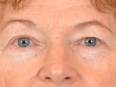 Eyelid Lift Before & After Gallery - Patient 741269 - Image 1