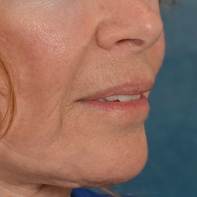 Lip Lift Before & After Gallery - Patient 261205 - Image 4