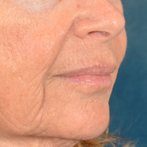 Lip Lift Before & After Gallery - Patient 261205 - Image 3