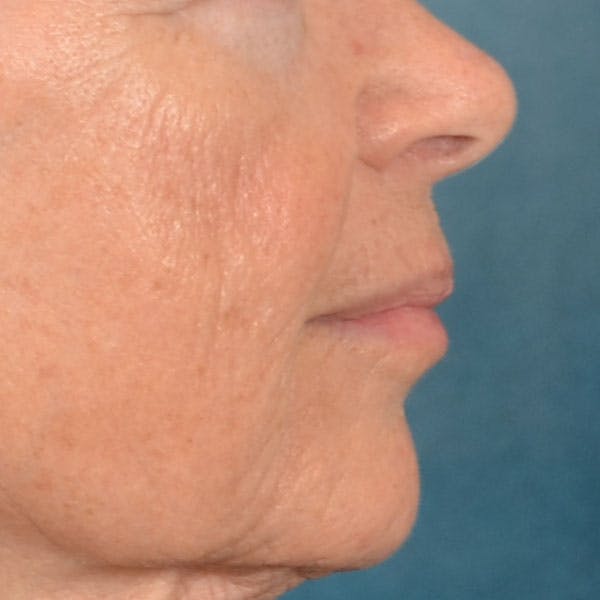 Lip Lift Before & After Gallery - Patient 261205 - Image 5