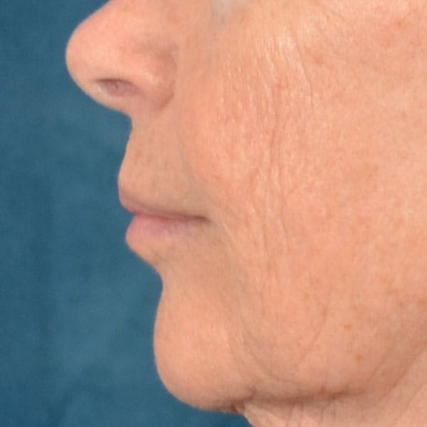 Lip Lift Before & After Gallery - Patient 261205 - Image 7