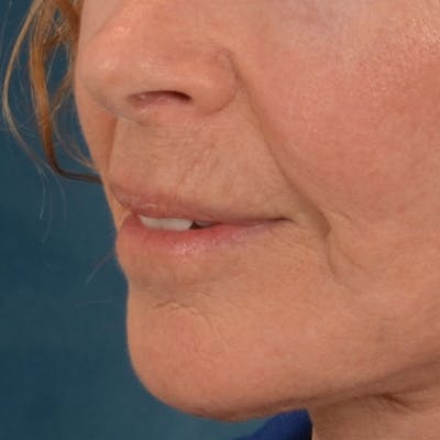 Lip Lift Before & After Gallery - Patient 261205 - Image 10
