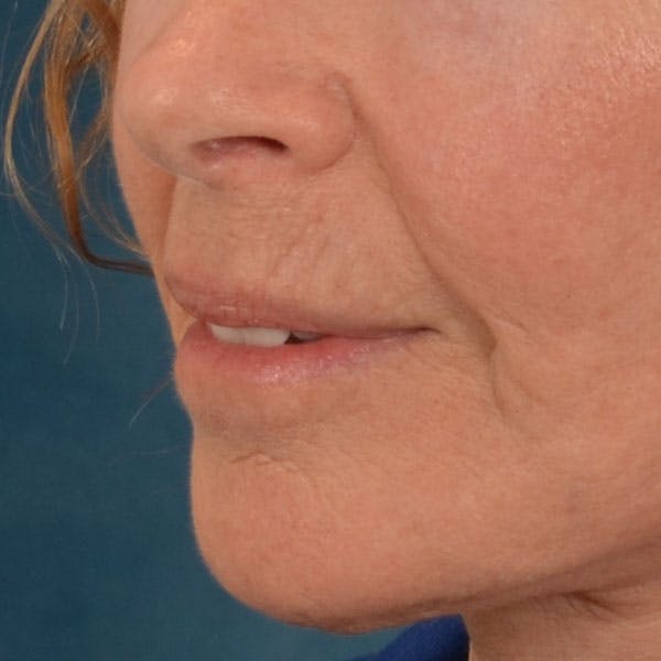 Lip Lift Before & After Gallery - Patient 261205 - Image 10