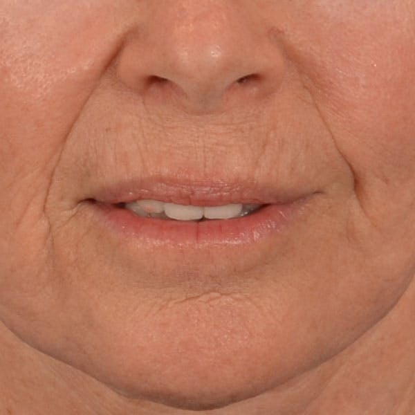 Lip Lift Before & After Gallery - Patient 261205 - Image 2
