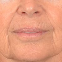 Lip Lift Before & After Gallery - Patient 261205 - Image 1