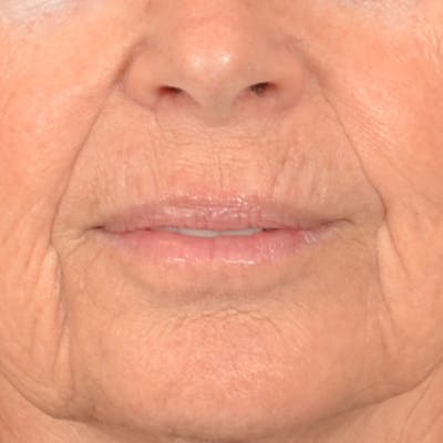 Lip Lift Before & After Gallery - Patient 261205 - Image 1