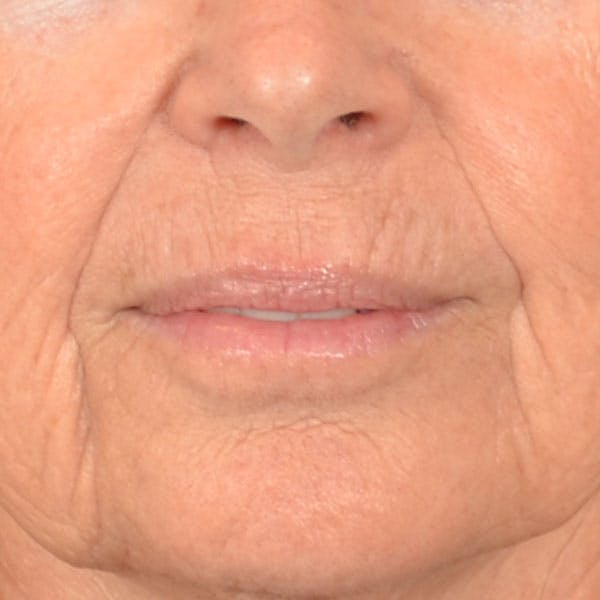 Lip Lift Before & After Gallery - Patient 261205 - Image 1