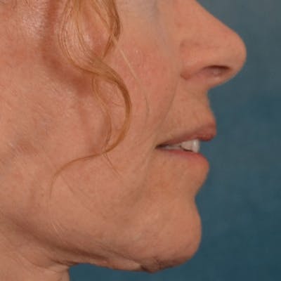 Lip Lift Before & After Gallery - Patient 261205 - Image 6