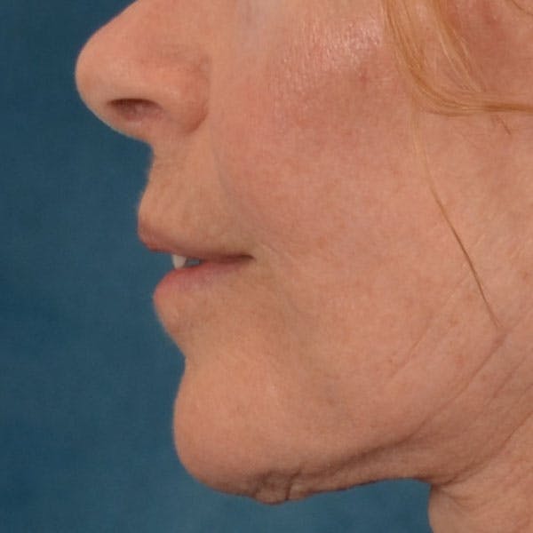 Lip Lift Before & After Gallery - Patient 261205 - Image 8