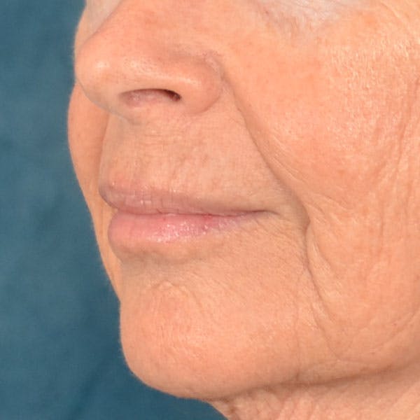Lip Lift Before & After Gallery - Patient 261205 - Image 9