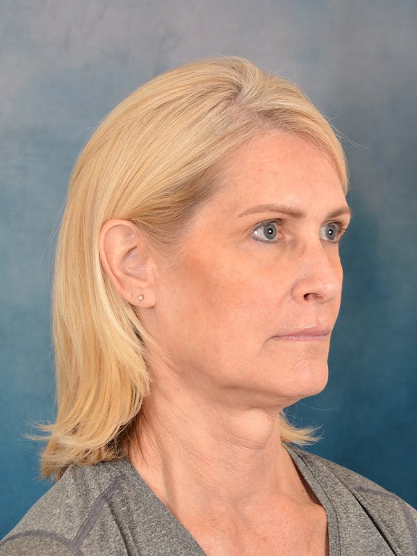 Laser Skin Resurfacing Before & After Gallery - Patient 114271 - Image 7