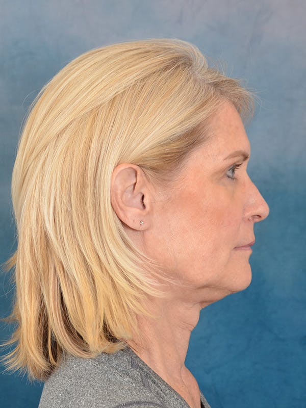 Laser Skin Resurfacing Before & After Gallery - Patient 114271 - Image 9
