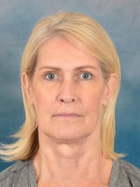 Laser Skin Resurfacing Before & After Gallery - Patient 114271 - Image 1