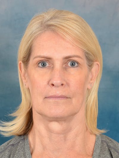 Laser Skin Resurfacing Before & After Gallery - Patient 114271 - Image 1