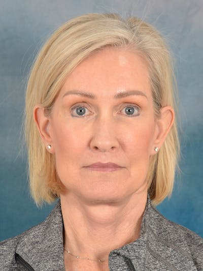 Laser Skin Resurfacing Before & After Gallery - Patient 114271 - Image 2