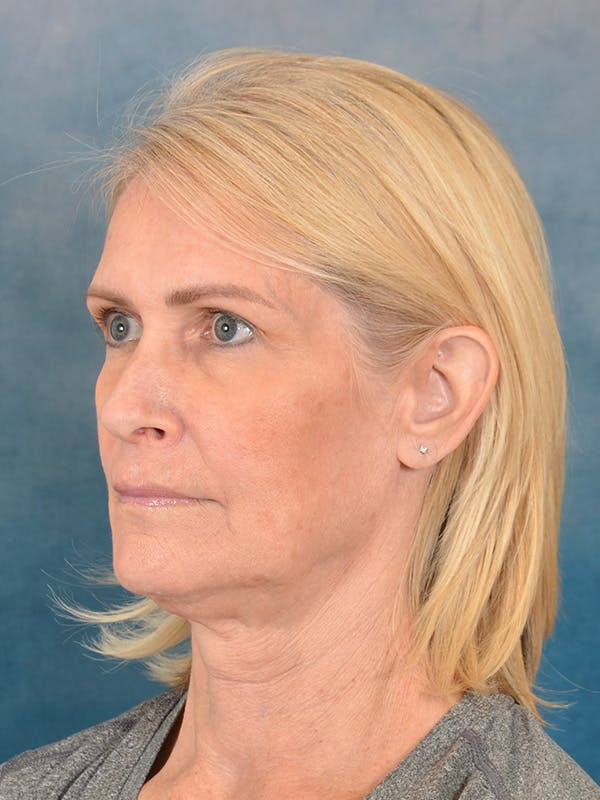 Laser Skin Resurfacing Before & After Gallery - Patient 114271 - Image 3