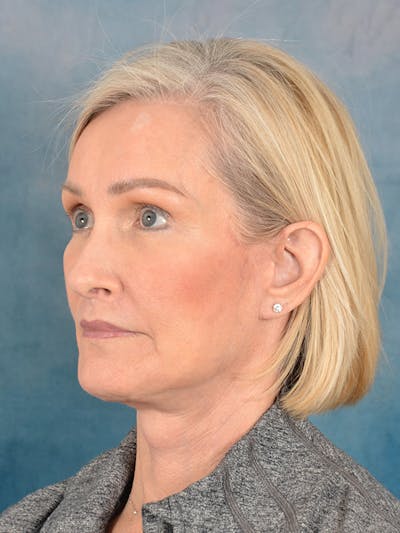 Laser Skin Resurfacing Before & After Gallery - Patient 114271 - Image 4