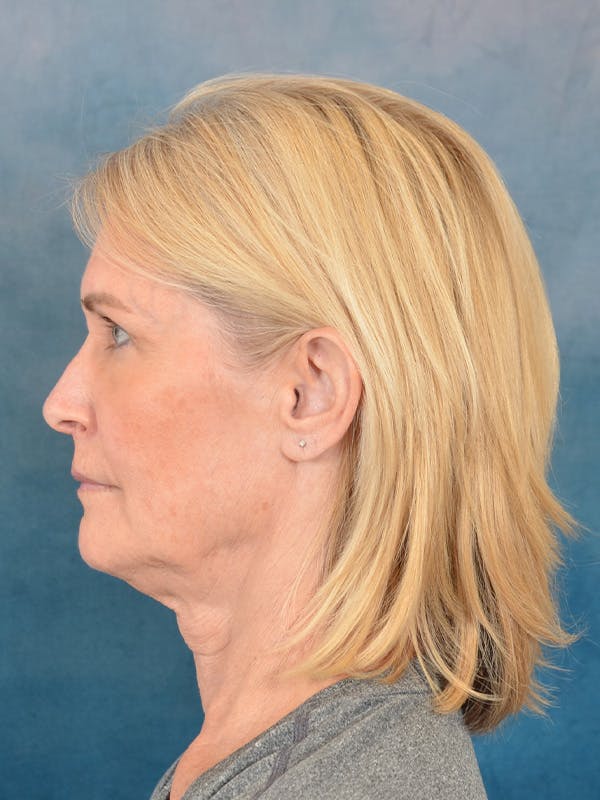 Laser Skin Resurfacing Before & After Gallery - Patient 114271 - Image 5