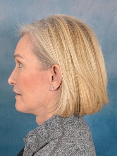 Laser Skin Resurfacing Before & After Gallery - Patient 114271 - Image 6