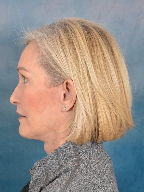 Laser Skin Resurfacing Before & After Gallery - Patient 114271 - Image 6