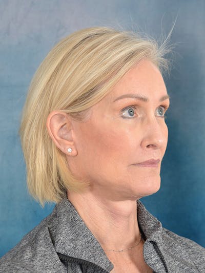 Laser Skin Resurfacing Before & After Gallery - Patient 114271 - Image 8