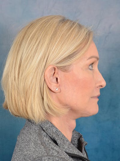 Laser Skin Resurfacing Before & After Gallery - Patient 114271 - Image 10