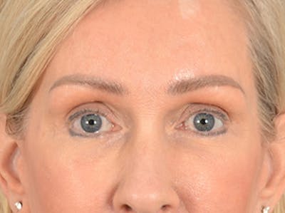 Eyelid Lift Before & After Gallery - Patient 400221 - Image 2