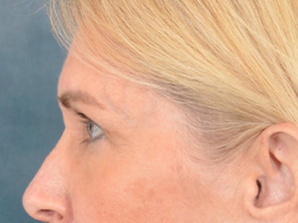 Eyelid Lift Before & After Gallery - Patient 400221 - Image 9