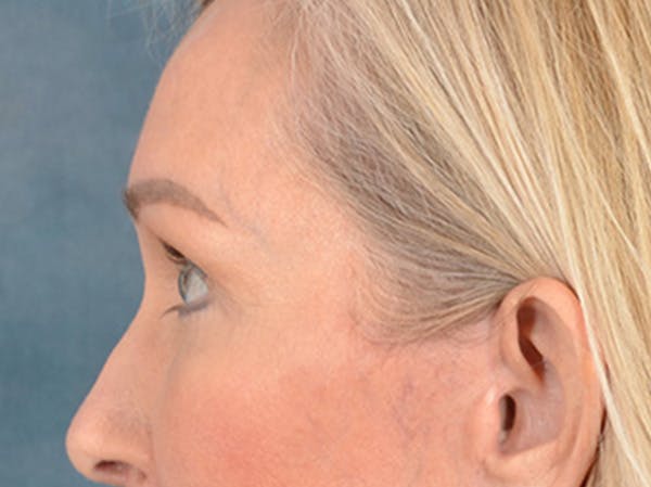 Eyelid Lift Before & After Gallery - Patient 400221 - Image 10