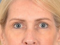 Eyelid Lift Before & After Gallery - Patient 400221 - Image 1