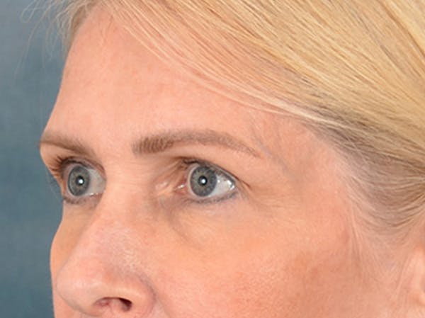 Eyelid Lift Before & After Gallery - Patient 400221 - Image 7